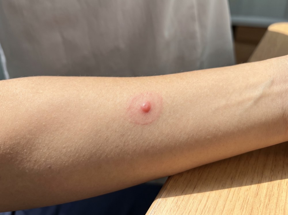 Close-up of a small red itchy bump on skin from a green lacewing bite that closely resembles a common mosquito bite